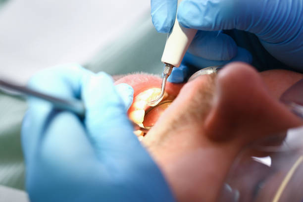 Best Emergency Wisdom Tooth Extraction in Edmonds, WA